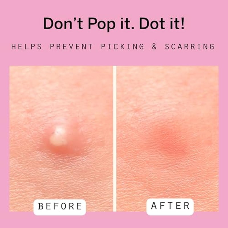 Dot Pimple & Zit Patches for Face ? All-Natural Custom Triple-Action Formula Absorbs, Clears & Brightens Acne Spots with Hydrocolloid, Vitamin C, Tea Tree Oil & Salicylic Acid (8 & 12 mm, 108 ct)