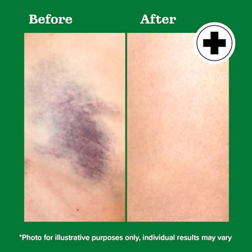 Arnica Bruise Gel - Natural Topical Recovery Gel with Vitamin K, 4 Fl Oz, 2-Pack