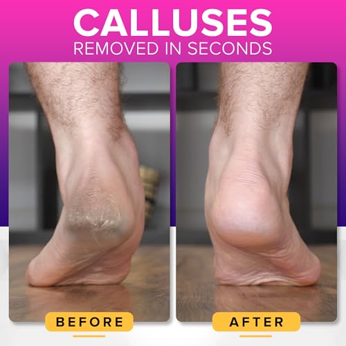 Pink Megafile & Smoothie Duo for Healthy Feet - Foot File & Callus Remover Set