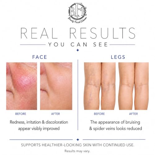 Vitamin K Cream with Arnica for Bruising Dark Circles & Spider Veins – Moisturizing Face & Body Care
