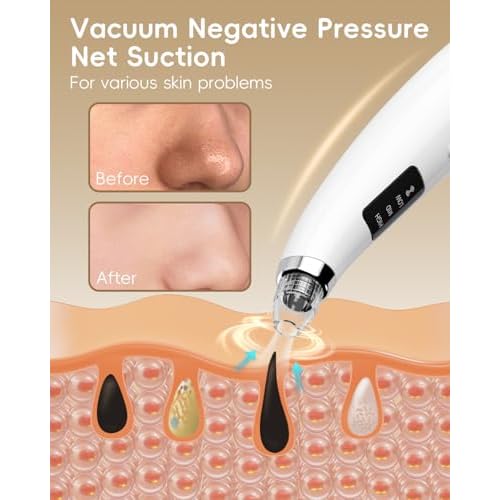 Rechargeable Blackhead Vacuum Pore Cleaner - 5 Attachments & 3 Suction Levels for Deep Facial Cleansing, USB-Powered Blackhead Remover for Women and Men (White)