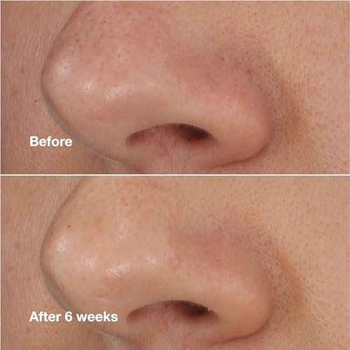 Self-Heating Blackhead Remover with Salicylic Acid for All Skin Types - 0.68 Fl Oz