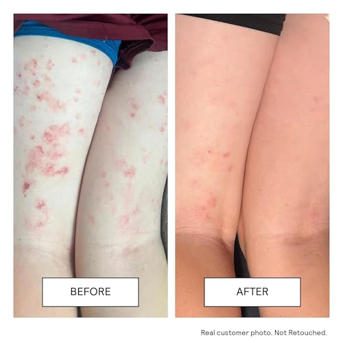 Moisturizing Cream for Sensitive Skin & Eczema Relief - Ceramides & Hyaluronic Acid