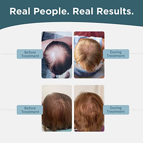 Shapiro MD 5% Minoxidil Hair Growth Serum for Men - 2 Fl Oz