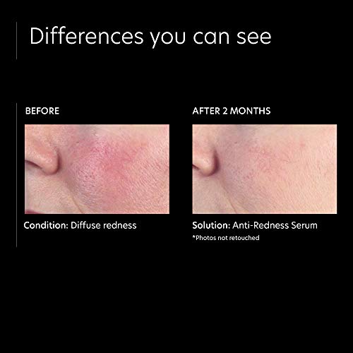 Anti-Redness Face Serum for Sensitive Skin - Calms & Soothes, 1 fl oz