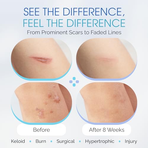 Medical Grade Silicone Scar Sheet Test Patch with Storage Case ? Reusable Silicone Scar Sheets for Surgical Scars, Acne, Burns, Keloids & More ? Try Before You Buy