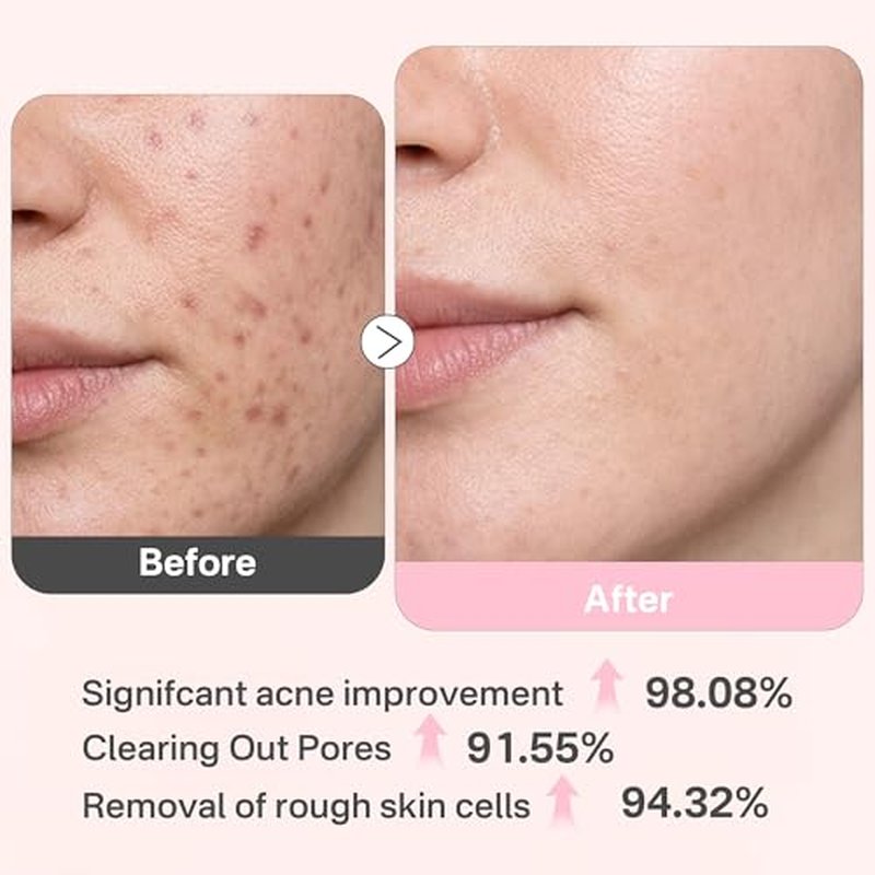 10pcs*5g Avocado Clay Mask Set, Clay Mud Mask, Moisturizing And Hydrating Skin, Blackhead Removal Men & Women Face Mask Skin Care Rejuvenating Facial Mask Travel Essential