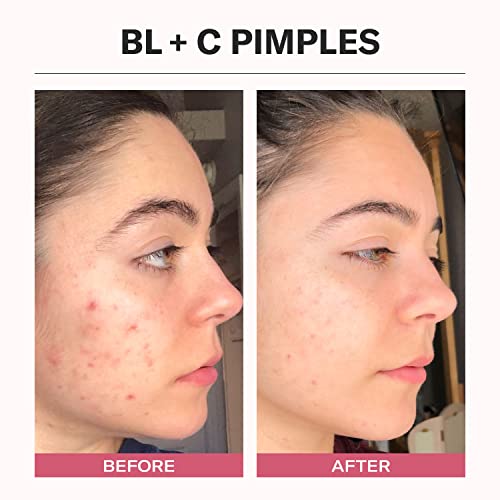 Odacit? Bl+C Serum Concentrate for Face, Luxury Black Cumin + Cajeput Pore-Clearing Facial Oil for Pimples & Blemishes, Vegan Vitamin E Spot Treatment for Oily, Acne-Prone Skin, 0.17 fl oz
