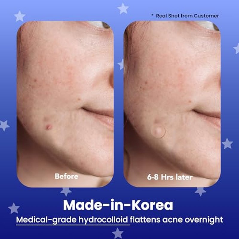 AVARELLE Spot Pimple Patches for Face | Good Night Acne Cover | Hydrocolloid with Tea Tree Oil | Acne Spot Treatment (12-14 mm, 24 ct)