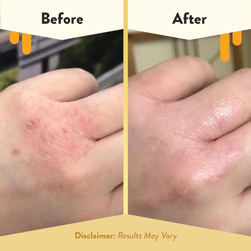 ECZEMA HONEY Original Skin-Soothing Cream & Oatmeal Body Lotion - Bundle for Sensitive Skin - Cruelty Free