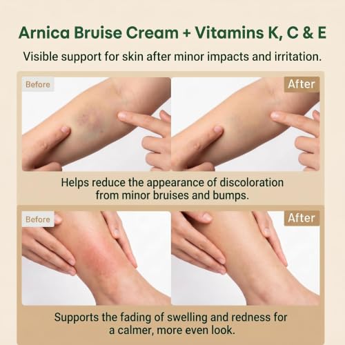 Arnica Bruise Cream with Vitamins K, C & E - Supports Skin Healing, 4.23 oz