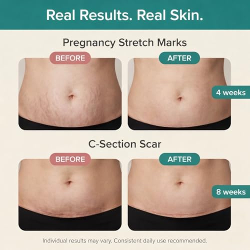 Pregnancy & Postpartum Stretch Mark Oil - Deep Hydrating Body & Scar Treatment