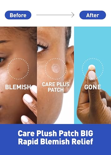 Hydrocolloid Acne Spot Patches - 102 Count, Strong Adhesion, Cover Zits & Blemishes, Trouble Skin Care, Pack of 5