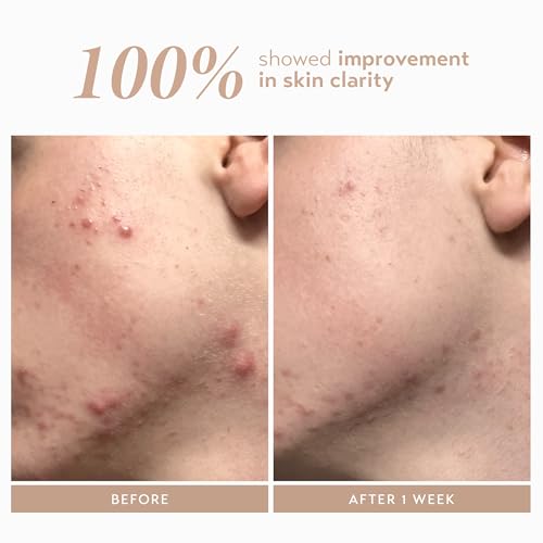 Shani Darden Azelaic Acid Serum - Brightening & Skin Tone Corrector, Vegan, 1 fl oz