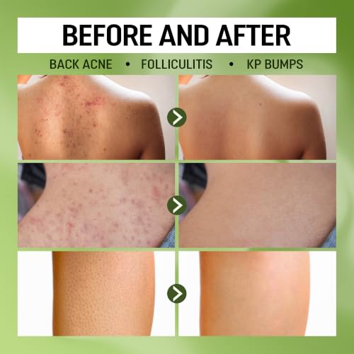 ABERA A.1 Box Folliculitis Body Wash with Wild Bitter Melon & BHA, 10.14 oz