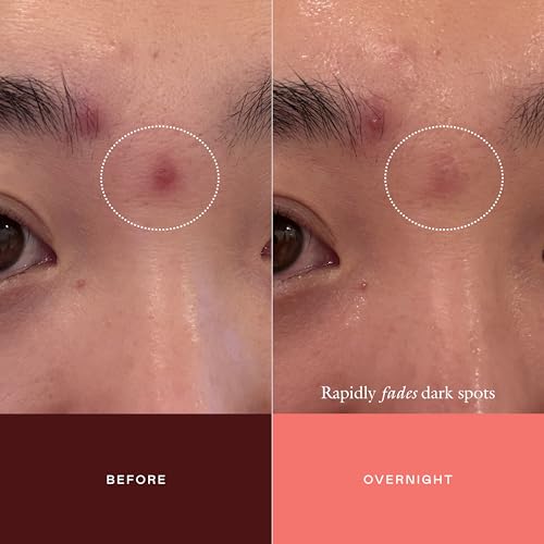 Dark Spot Serum with Tranexamic Acid - Targeted Face Concentrate for Hyperpigmentation
