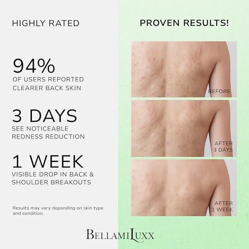 BellamiLuxx Back and Body Acne Treatment Spray: 2% Salicylic Acid &