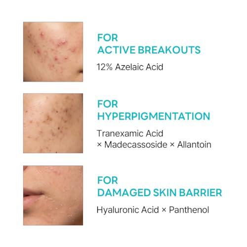 Azelaic Acid Serum 12% for Rosacea & Acne Prone Skin - Soothing & Brightening