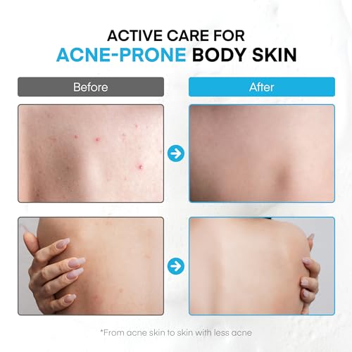 Antibacterial Body Wash 2-Pack for Body Acne & Odor - Men & Women