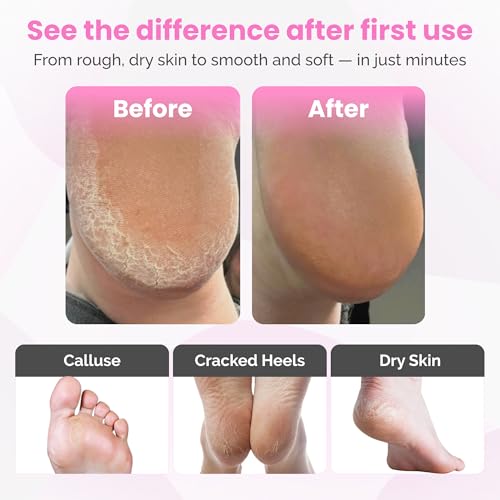 Electric Foot Callus Remover Tool with 60 Sanding Discs & Adjustable Speed – Professional Foot Grinder for Exfoliation