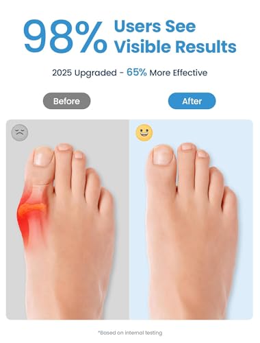 4PCS Bunion Corrector Toe Separators for Women Men - Breathable Toe Spacers for Bunion Relief & Alignment