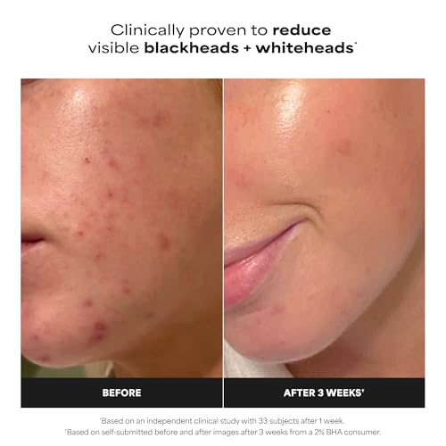 Paula's Choice 2% BHA Liquid Exfoliant for Face - 4 Fl Oz Pack of 2