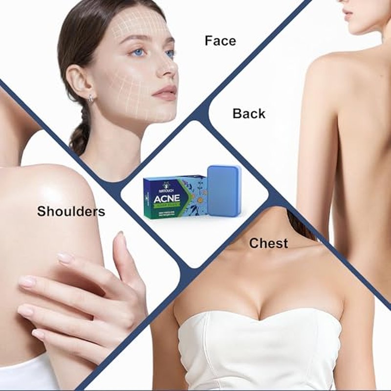 Acne Treatment Bar Soap for Face and Body, Medicated Soap Bar Treats Acne Pimples, Whiteheads, Blackheads, Acne Scars and Dark Spot Remover with Tea Tree Oil, Soap Bar for Acne, 4 oz, 1-Pack
