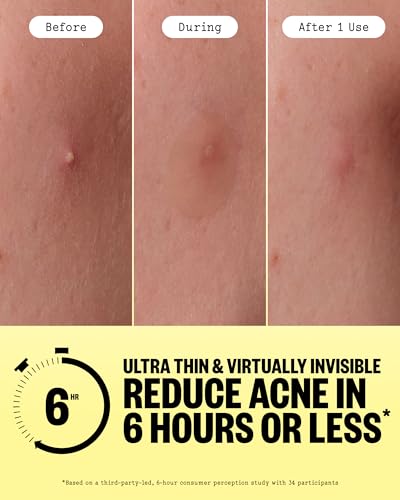 Acne Day Dot Invisible Hydrocolloid Pimple Patches - 40 Count - Discreet & Gentle Blemish Cover