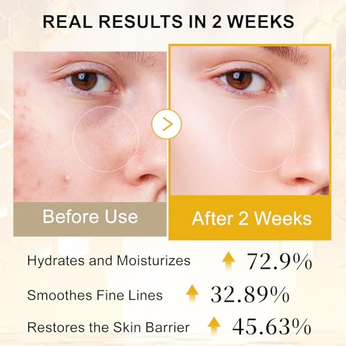 Bee Venom Serum with Sodium DNA PDRN & Acetyl Hexapeptide-8, Smoothing Lines, Hydrating & Firming Skin Facial Serum for Radiant, Healthy-Looking Skin 0.67 Fl.Oz