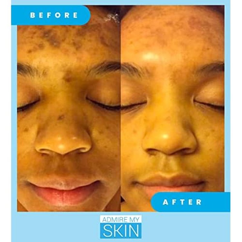 Admire My Skin Dark Spot Corrector Serum + Retinoid Cream Set