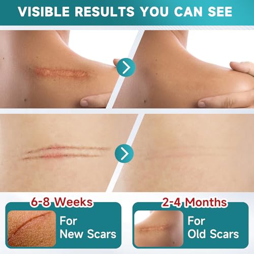 Silicone Scar Sheets 10 Pcs - Soft Medical Tape for Surgical & Keloid Scars, 5.7 x 1.57 Inches