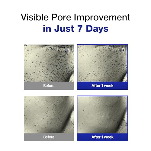 Smaller Pores Toner Pads for Oil Control & Black Spots - 70 Count
