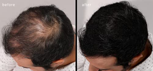 Hair Building Fibers for Thinning Hair - Natural Thickening - Dark Brown - 2 Months+ Supply