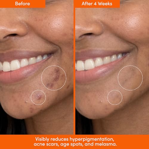 Tranexamic Acid Dark Spot Serum with AHA for Face & Body - Brightening Night Treatment