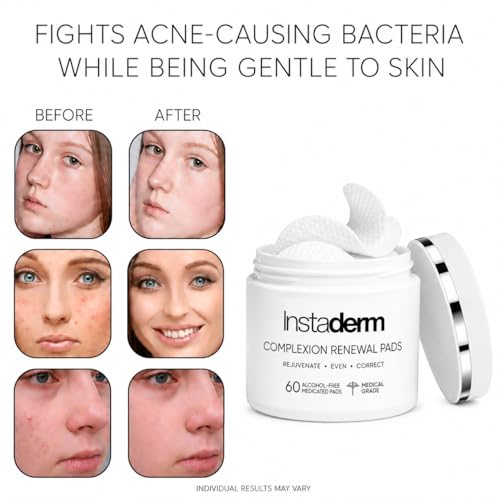 Acne Treatment Pads with Salicylic, Glycolic & Lactic Acid - Exfoliating Facial Pads for Blackheads & Oily Skin