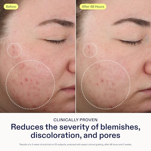 Skinfix Acne & Skin Barrier Set with BHA Cleanser, Retinoid Gel & Moisturizer