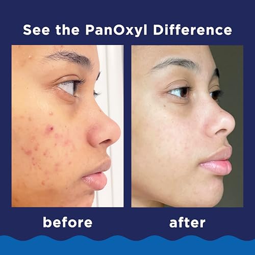 Pimple Patches for Face, 4 Size 300 Counts Acne Patches, Hydrocolloid Patches for Covering Zits and Blemishes, Spot Stickers with Salicylic Acid, Tea Tree Oil & Calendula Oil