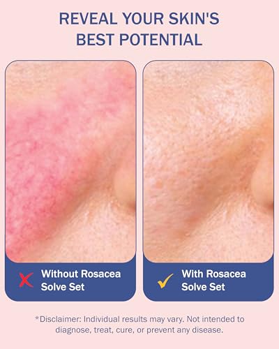 Rosacea Treatment Skincare Set - Face Wash, Cream & Serum - 12.25 Fl Oz Pack of 3