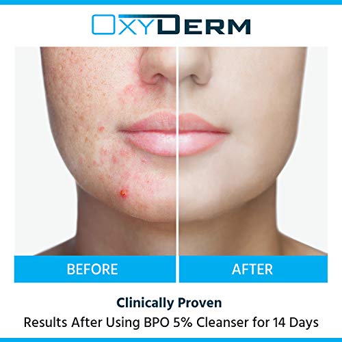 Acne Face wash Treatment with Benzoyl Peroxide 5% - Clinically Proven Wash to Fight Acne Blemishes on Contact. Eliminates Cystic Breakouts, Oily Skin, Clogged Pores, Blackhead, Whitehead, & Pimples.