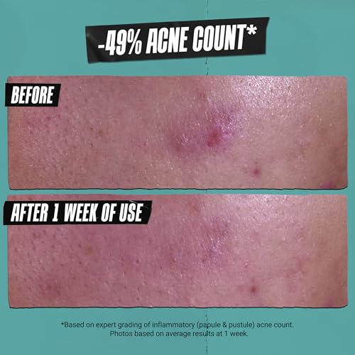 Acne Treatment Cleansing Paste with Charcoal & Salicylic Acid - 4.2 fl oz