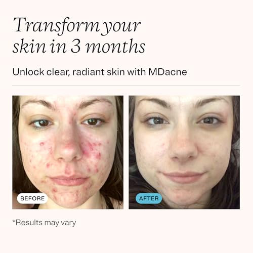 Micronized Benzoyl Peroxide Acne Treatment Cream with Hydrating Ingredients