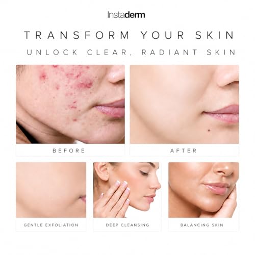 Acne Treatment Pads with Salicylic, Glycolic & Lactic Acid - Exfoliating Facial Pads for Blackheads & Oily Skin