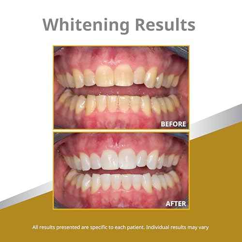 Opalescence 45% Syringes Teeth Whitening Gel - with PF - (12 Syringes) Refill Kit Carbamide Peroxide. Made by Ultradent, in Mint Flavor. Tooth Whitening 5359-6