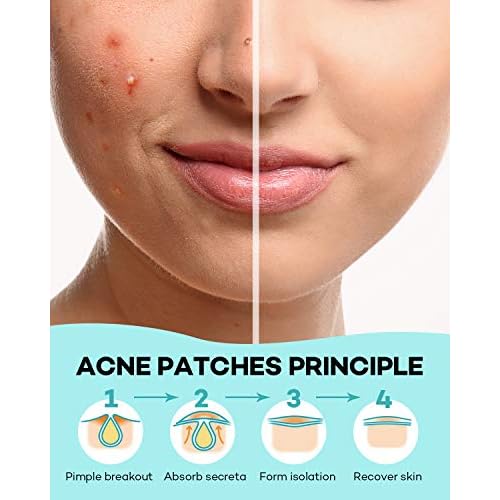 TKTK Pimple Patch Acne Patch, 4 Sizes 140 Patches Acne Absorbing Cover Patch, Hydrocolloid Invisible Acne Patches for Face Zit Patch Acne Dots Tea Tree, Calendula Oil