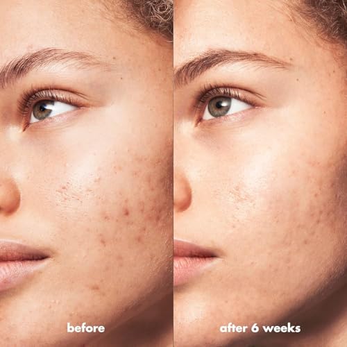 e.l.f. SKIN Blemish Breakthrough Calming Water Cream - Lightweight Acne Face Moisturizer 1.68 Fl Oz Pack of 2