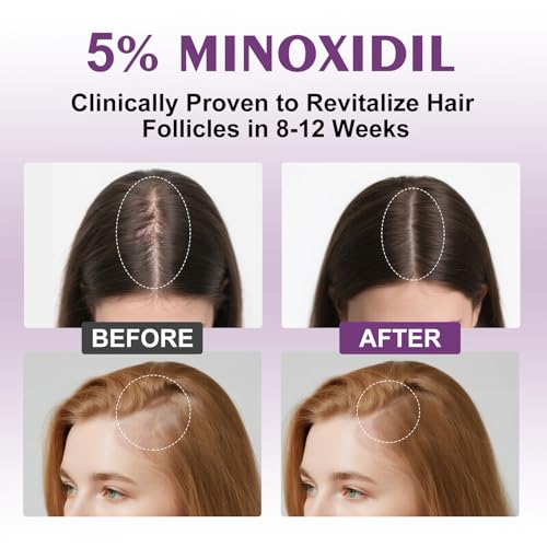 5% Minoxidil Spray for Women with Biotin, 13oz—Regrowth Solution for Thicker Hair