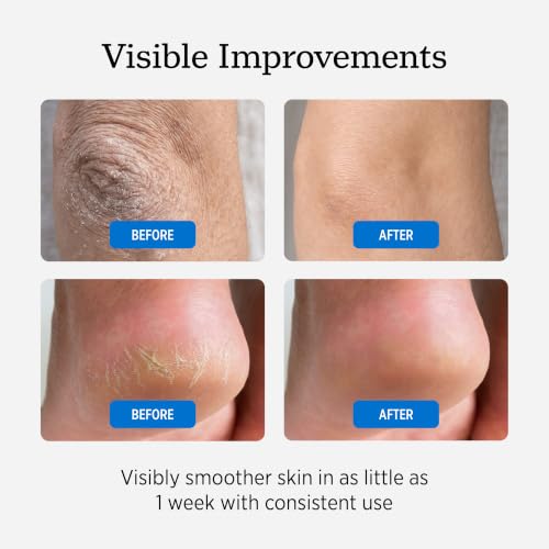 NUVADERMIS Urea Cream 40% for Feet - Max Strength Moisturizer, 5.3 oz Pack of 2