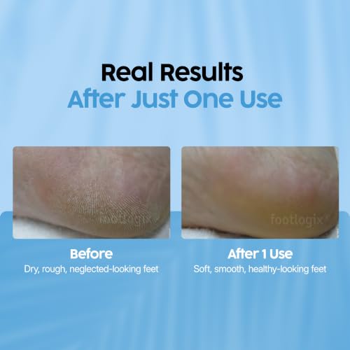 Footlogix Urea Foot Moisturizer Mousse for Dry & Callused Feet 4.23 oz