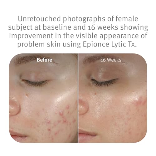 Epionce Lytic Tx Facial Retexturizing Lotion - Blemish & Pore Minimizer