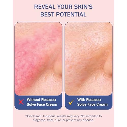 Rosacea Treatment for Face Skincare Cream for Women & Men (Pack of 2) - Gentle Moisturizer Redness Reducing Skin Care - with Aloe Vera & Hyaluronic Acid - Day-Night, Made in USA by e70 (2.25 fl. oz.)